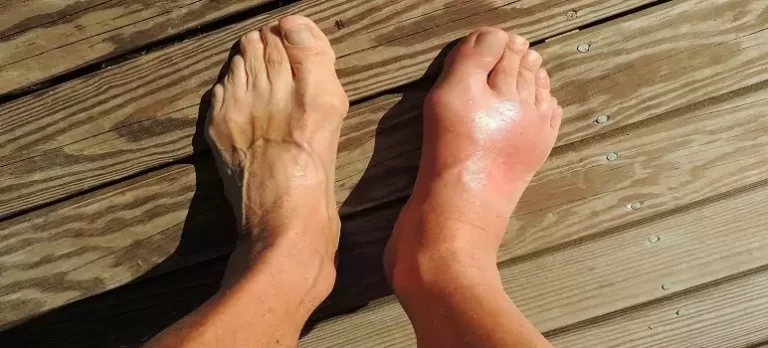 causes-of-gout-disease