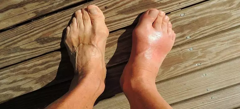 causes-of-gout-disease