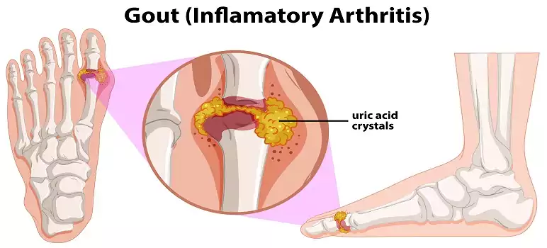 what-are-causes-of-gout-disease-symptoms-and-treatment